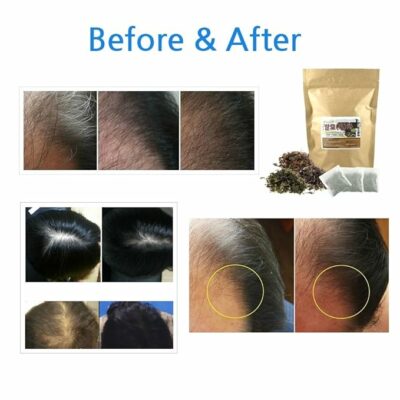 Hair Restoration Tea 100% Natural Herbal Tea for Helping Regrowth 15 Teabags